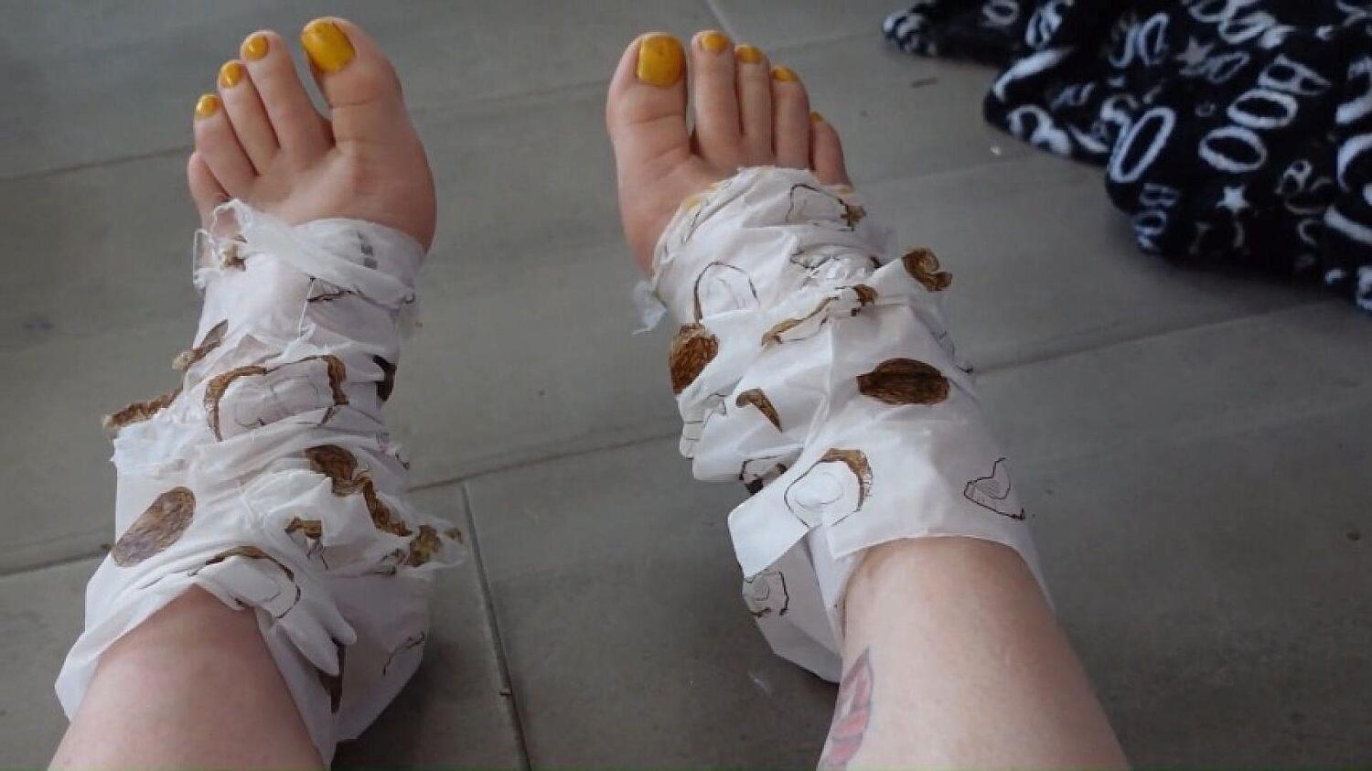 Foot Growth From Moisturizing Socks